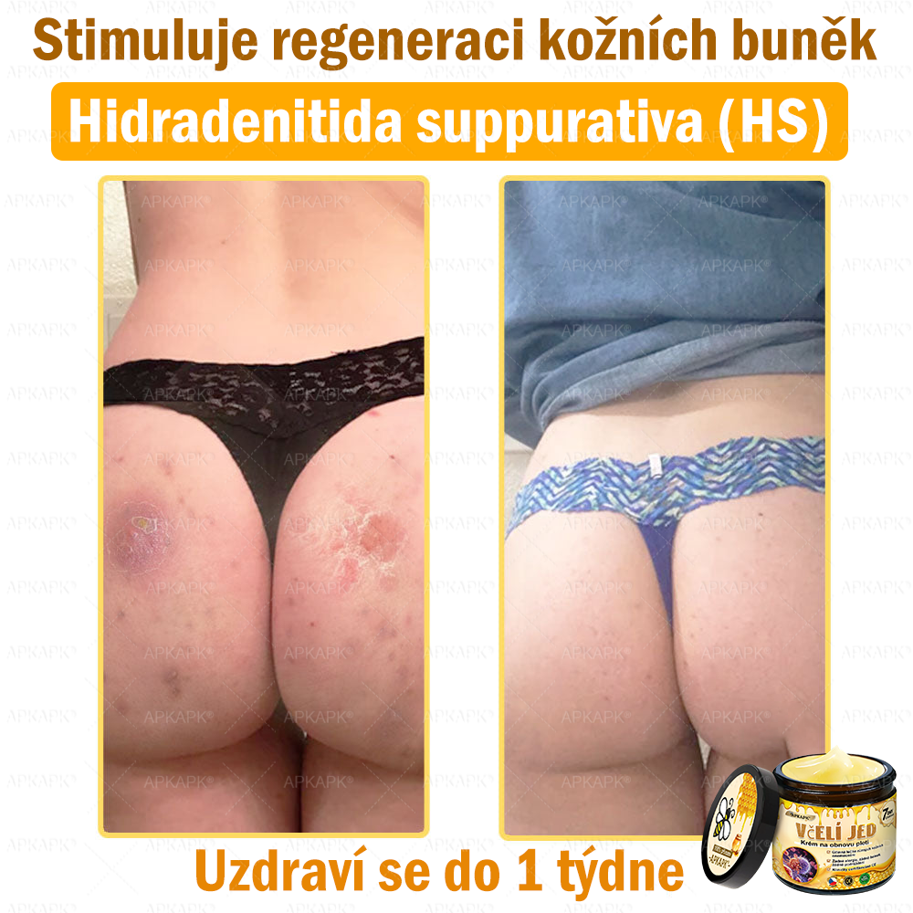 Dermatologicky a klinicky testováno🎁🐝APKAPK®Bee Venom Krém na obnovení pleti🐝 pomáhá při léčbě kožních problémů, jako jsou: vrásky, jizvy, pigmentové skvrny, strie, akné, psoriáza, ekzém, kožní změny, podráždění, záněty a další kožní problémy.