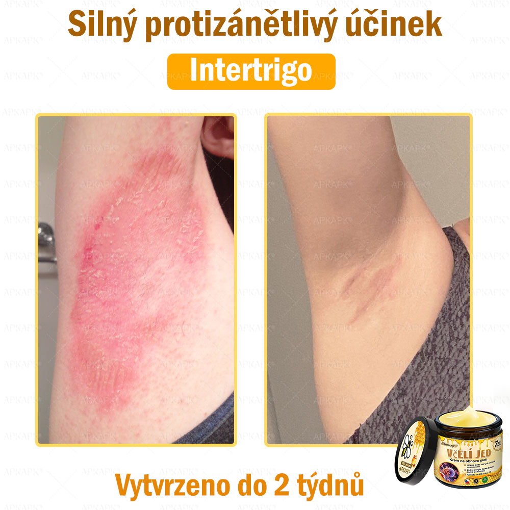 Dermatologicky a klinicky testováno🎁🐝APKAPK®Bee Venom Krém na obnovení pleti🐝 pomáhá při léčbě kožních problémů, jako jsou: vrásky, jizvy, pigmentové skvrny, strie, akné, psoriáza, ekzém, kožní změny, podráždění, záněty a další kožní problémy.