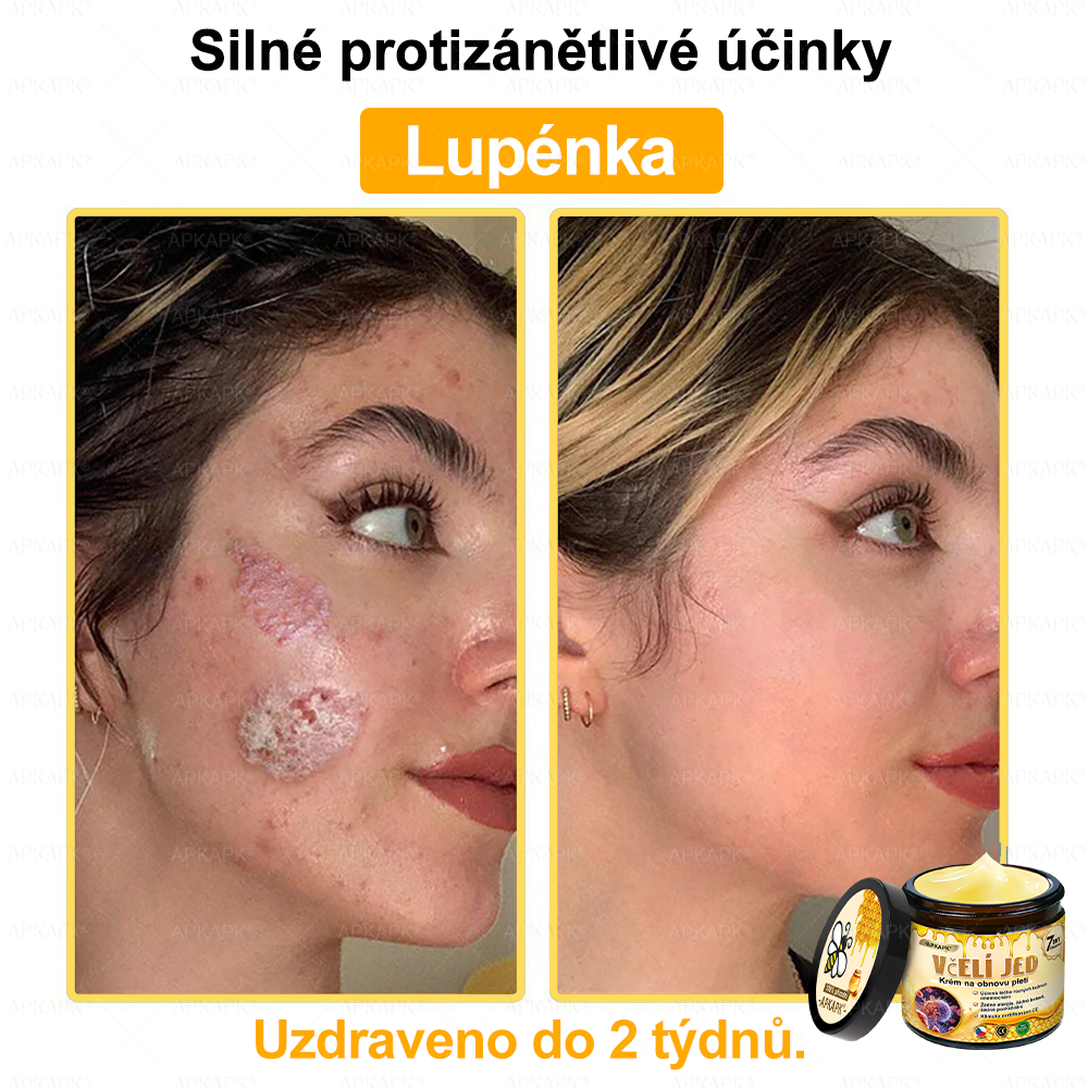 Dermatologicky a klinicky testováno🎁🐝APKAPK®Bee Venom Krém na obnovení pleti🐝 pomáhá při léčbě kožních problémů, jako jsou: vrásky, jizvy, pigmentové skvrny, strie, akné, psoriáza, ekzém, kožní změny, podráždění, záněty a další kožní problémy.