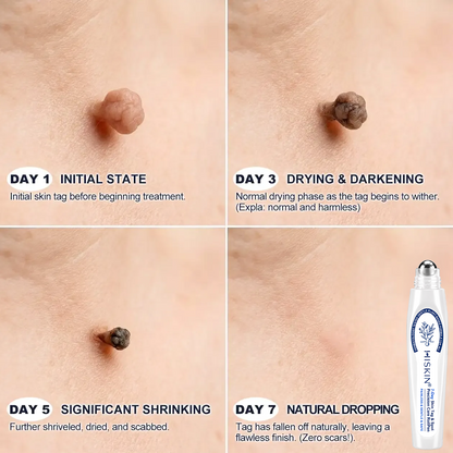 🔥 Save Up to 50% | HISKIN® Skin Tag & Spot Eraser Rollerball Pen | Fast & Gentle Skin Care
