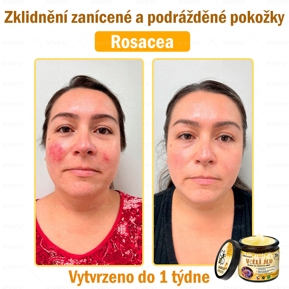Dermatologicky a klinicky testováno🎁🐝APKAPK®Bee Venom Krém na obnovení pleti🐝 pomáhá při léčbě kožních problémů, jako jsou: vrásky, jizvy, pigmentové skvrny, strie, akné, psoriáza, ekzém, kožní změny, podráždění, záněty a další kožní problémy.