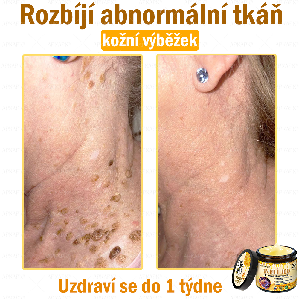 Dermatologicky a klinicky testováno🎁🐝APKAPK®Bee Venom Krém na obnovení pleti🐝 pomáhá při léčbě kožních problémů, jako jsou: vrásky, jizvy, pigmentové skvrny, strie, akné, psoriáza, ekzém, kožní změny, podráždění, záněty a další kožní problémy.