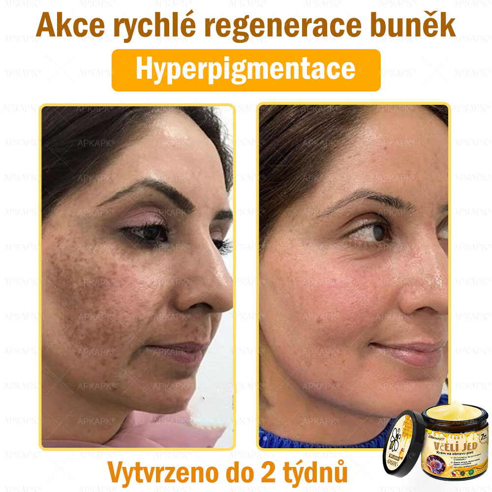Dermatologicky a klinicky testováno🎁🐝APKAPK®Bee Venom Krém na obnovení pleti🐝 pomáhá při léčbě kožních problémů, jako jsou: vrásky, jizvy, pigmentové skvrny, strie, akné, psoriáza, ekzém, kožní změny, podráždění, záněty a další kožní problémy.